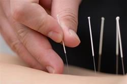 An acupuncture needle being placed